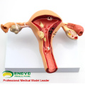 VENDER 12441 Útero femenino Mostrar patologías comunes Modelos de anatomía